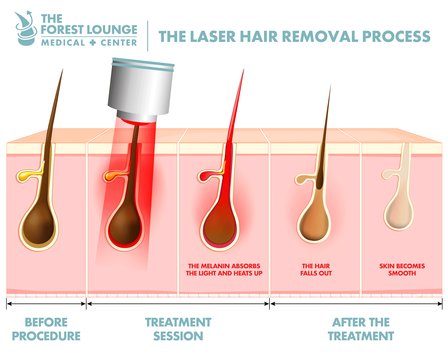 Laser Hair Removal in Lake Forest IL. Permanent Hair Removal