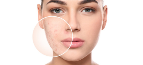 Acne Facial Muscle IV Therapy Infusion in Lake Forest IL